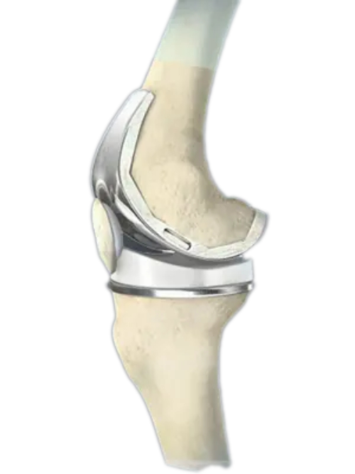 conformis-knee conformis knee replacement hardware